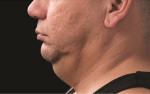Submental Area (Double Chin)