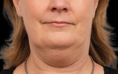 Submental Area (Double Chin)