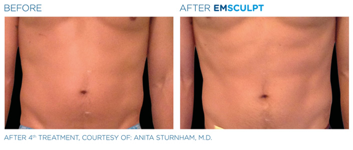 Before and After Emsculpt Treatment, courtesy of Anita Sturnham, MD