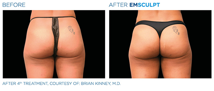 Before and After Emsculpt Treatment, courtesy of Brian Kinney, MD