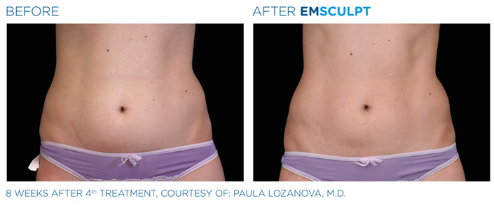 Before and After Emsculpt Treatment, courtesy of Dr. Paula Lozanova