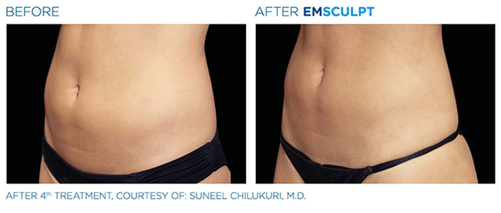 Before and After Emsculpt Treatment, courtesy of Suneel Chilukuri, MD